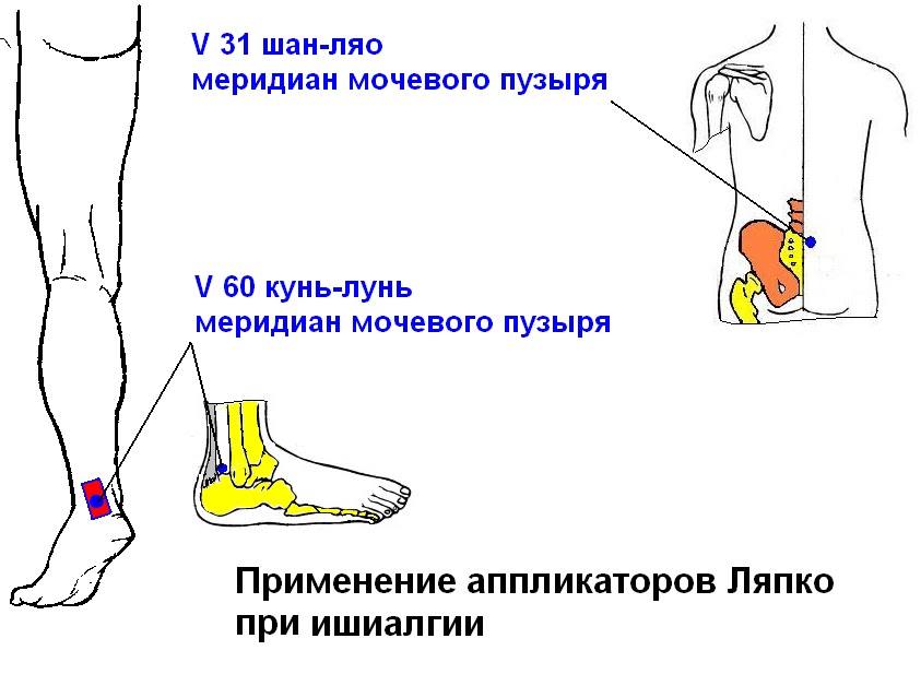 Могут ли возникать боли в спине и пояснице при геморрое